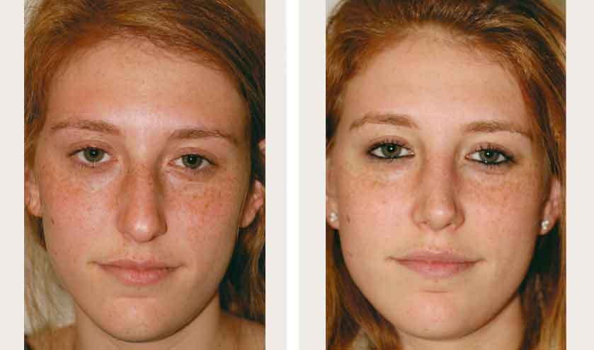 Facial Makeover Surgery
